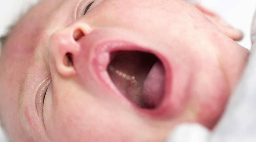 Ke parë pika të vogla të bardha në gojën e bebit? Ja ç'duhet të dish