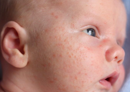 Bebi im ka shumë puçrra në fytyrë. Duhet të shqetësohem?